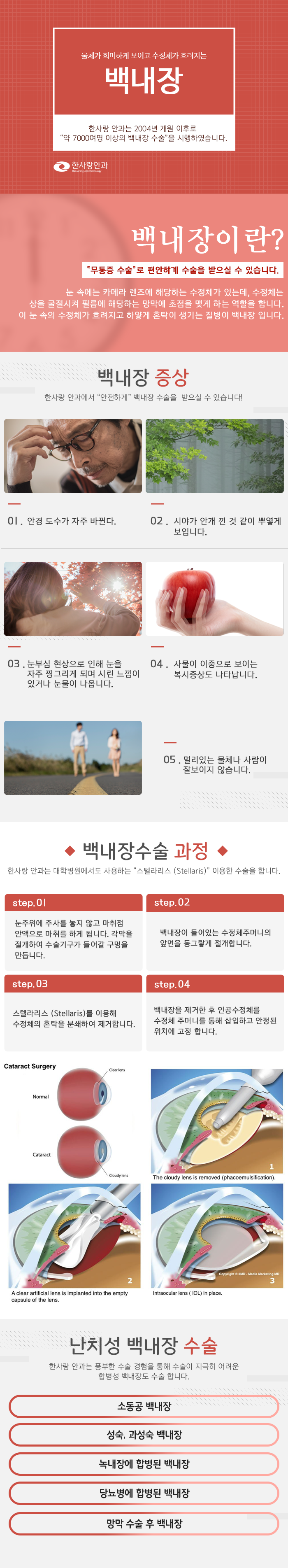 백내장_m